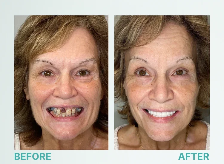 ✅ Advanced Custom-Fit Functional Dentures 🦷 Smile Confidently Again in Just 3 Minutes ❌ No Dentist Needed!